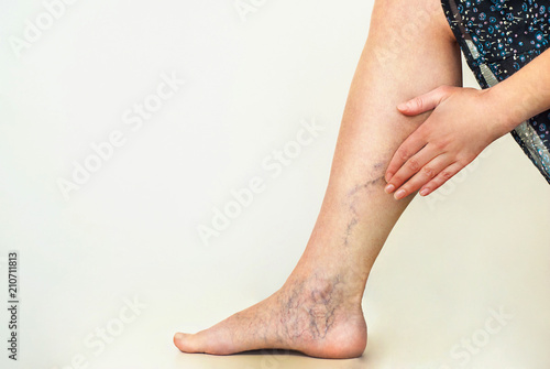 Varicose veins on the womans legs