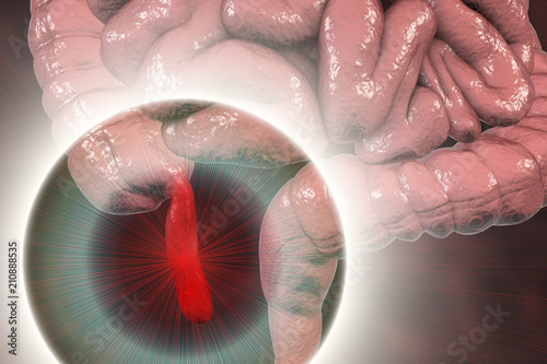 Acute appendicitis, 3D illustration showing inflammed appendix on the cecum