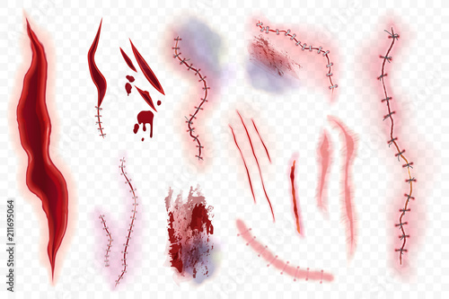 Realistic vector surgical stitches, scars, bruise and slaughter set isolated on the alpha transperant background. Bloody scar.