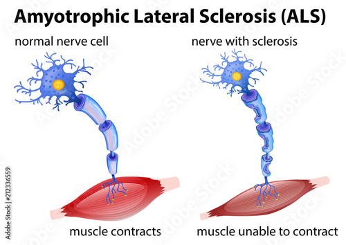 Amyotrophic lateral sclerosis concept