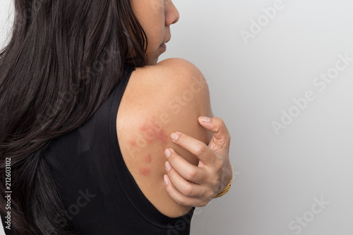 woman showing her skin itching behind , with allergy rash urticaria symptoms