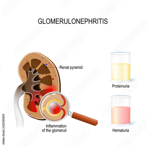 Glomerulonephritis (glomerular nephritis). Human kidney, and close-up glomeruli with inflammation and two glasses with urine