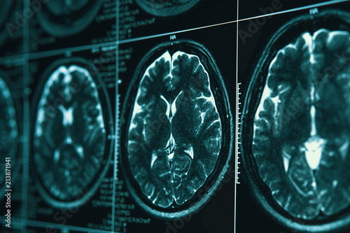 MRI or magnetic resonance image of head and brain scan. Close up view