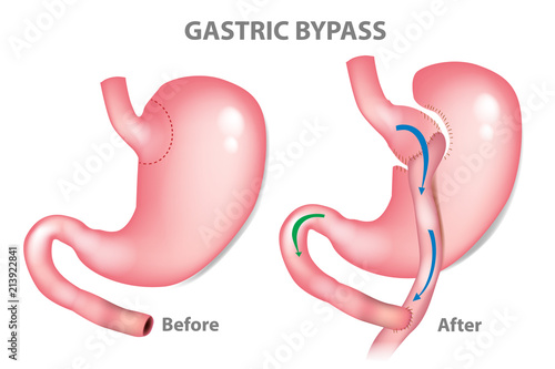 Gastric bypass surgery - RNY (Roux-en-Y ). MINI-GASTRIC BYPASS