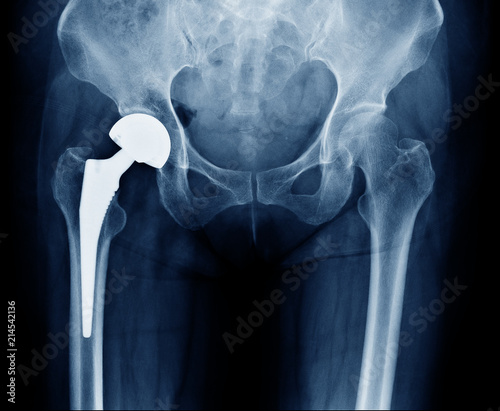 X-ray scan image of hip joints with orthopedic hip joint replacement or total hip prosthesis on right side implant head and screws in human skeleton in blue gray tones.