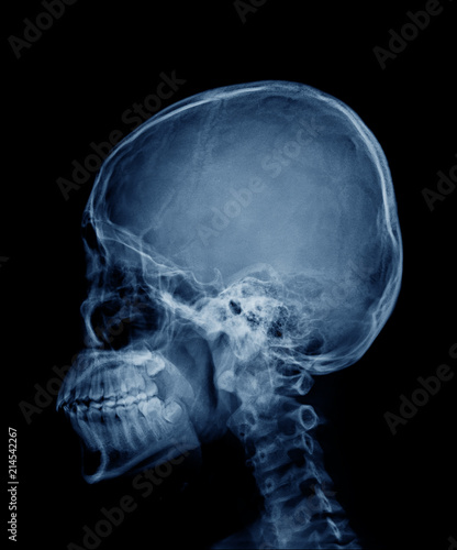 head skull x-ray side view in blue tone