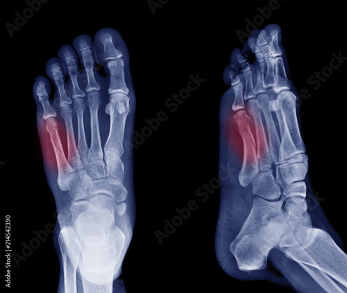 x-ray image of bone fracture at 5th Metatarsal left foot