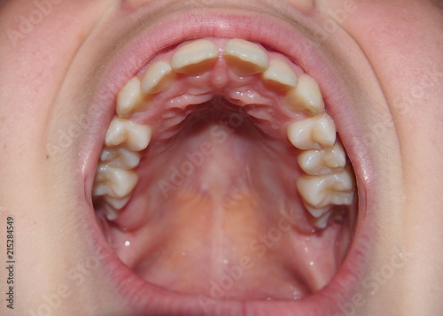 Healthy upper jaw with teeth close up