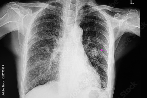 Chest xray of patient with pneumonia and lung nodule