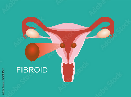 Illustration of the uterine fibroid, Womb anatomy