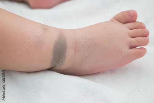 The little foot with birthmark. This birthmark will disappear in the future. (Called Mongolian spot)