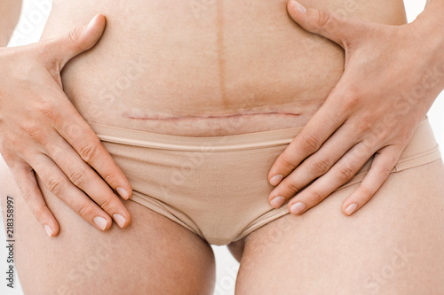 closeup of woman's belly with a scar from a cesarean section or surgery or operation