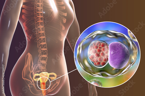 Female chlamydiosis, medical concept. 3D illustration showing close-up view of Chlamydia trachomatis bacteria infecting cells of cervix uteri