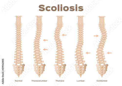 type, scoliosis medical anatomical vector / backbone / organ