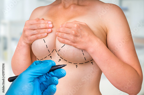 Dotted lines on female body for lifting and breast augmentation