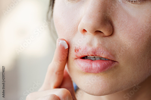 Part of a young woman's face with a virus herpes on lips, treatment with ointment