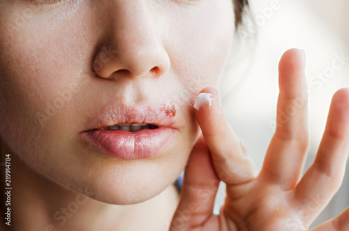 Part of a young woman's face with a virus herpes on lips, treatment with ointment