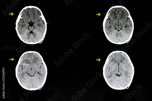 a child with subdural hematoma