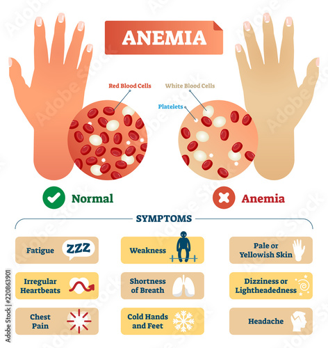 Anemia vector illustration. Labeled scheme with red blood cells.