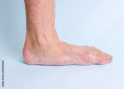 The left leg of a man with signs of joint disease and flat feet.