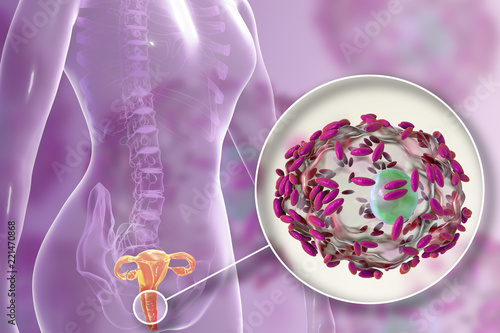 Bacterial vaginosis. Vaginal secretions contain epithelial cells, so-called clue cells covered with bacteria Gardnerella vaginalis, 3D illustration