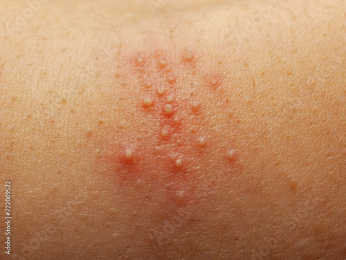 Close up of girl has rash and other nonspecific skin eruption on her shoulders. May be caused by dirt, virus, mold, or bacteria. The doctor is currently diagnosed