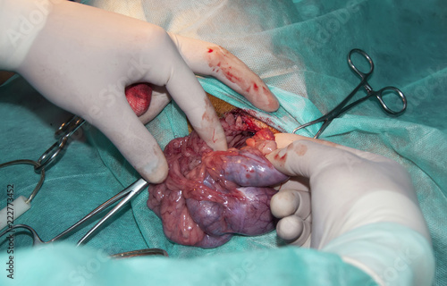 close-up of surgical operation for removing the intestinal cancer (concept surgery)