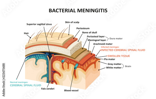 Bacterial meningitis