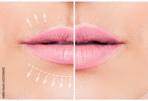 Beautiful pink lips before and after filler injection collagen to increase the volume of the lips. Beauty concept. Female lips, augmentation procedure