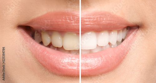 Smiling woman before and after teeth whitening procedure, closeup