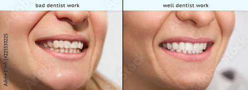 Smiled woman with bad and well dental prosthetic