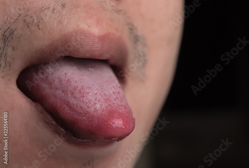 Close up of tongue with ulcers