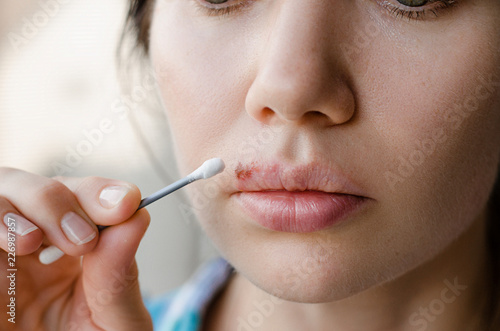 Part of a young woman's face with a virus herpes on lips, treatment with ointment