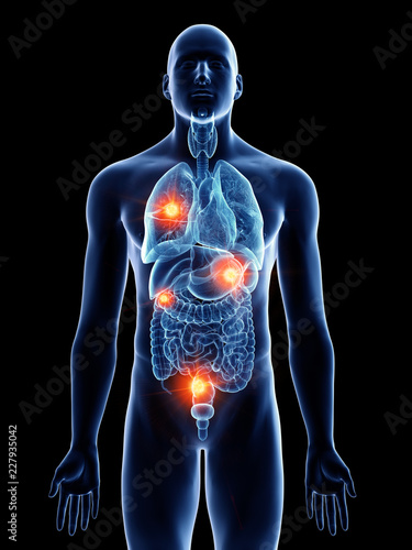 3d rendered medically accurate illustration of a man with metastases