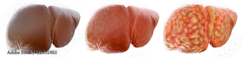 Realistic stages of a fatty liver - 3D Rendering