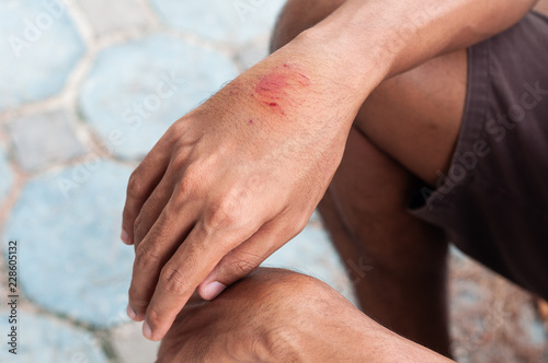 Unidentified man hand vaccines that are bitten by mammals are susceptible to rabies. Fresh wounds are susceptible to infection.