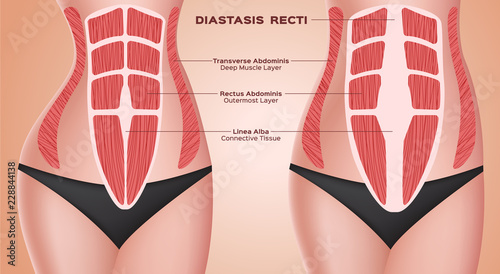 diastasic recti . abdominal . before after pregnancy vector / anatomy