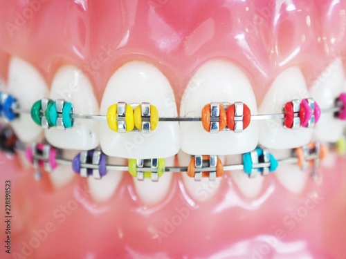 Close up orthodontic model and dentist tool - demonstration teeth model of multi color of orthodontic bracket or brace