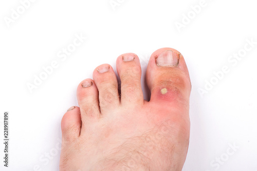 purulent pimple on toe