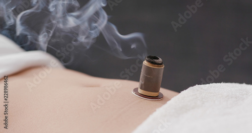 Chinese traditional medicine moxibustion therapy