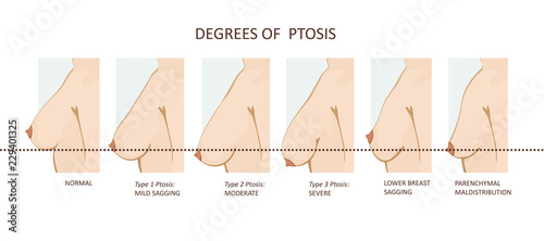Degrees of breast ptosis