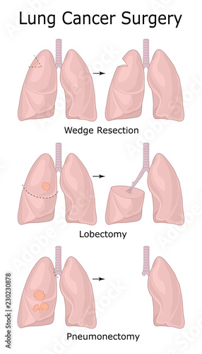 Illustration of lung cancer surgery