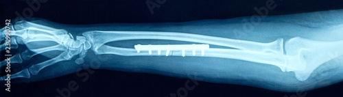 Film x-ray show fracture shaft of arm insert plate and screw for fix arm’s bone