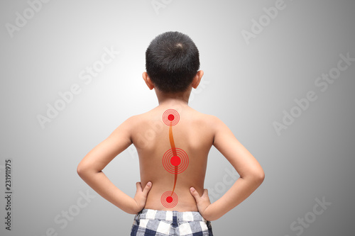 Asian kid with scoliosis, isolated on white background