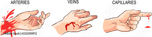 vector illustration of a Arterial and venous bleeding