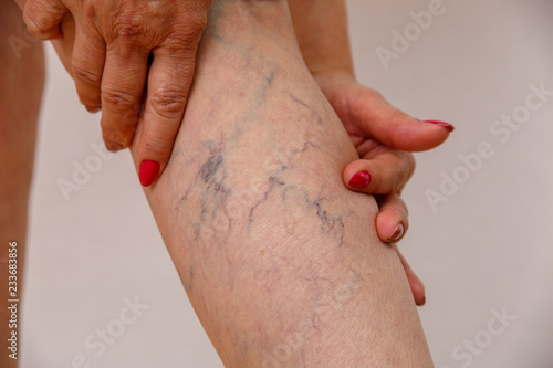 An elderly woman in white panties is touching her legs with cellulite and varicose veins on a light isolated background. Concept for medicine and cosmetology.