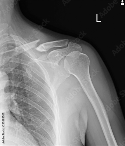 Chest x-ray Fractures left clavicle, anterior 2nd rib, posterior rib 4,5 and lateral aspect of left 6 th rib.