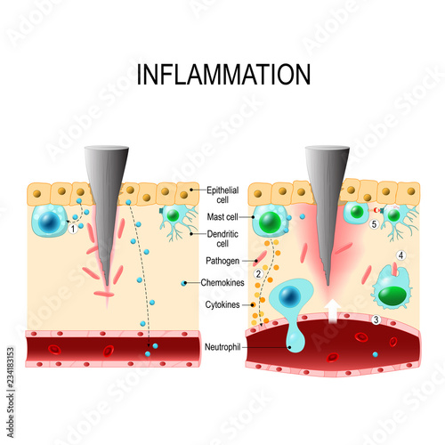 Inflammation. Immune system