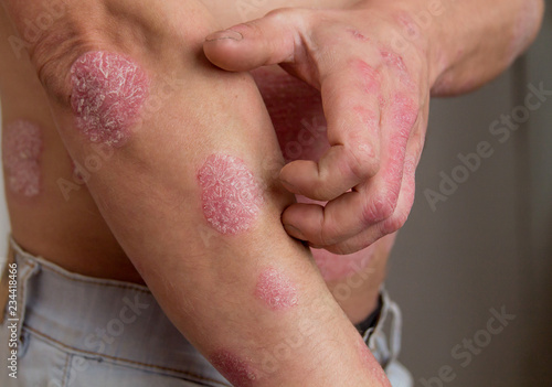 the man on the arm and abdomen spots psoriasis