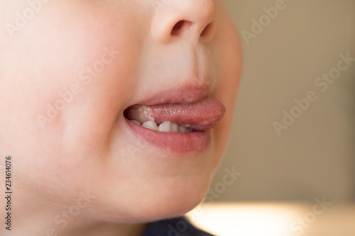 Close-up of Little kid boy with Aphtha or Stomatitis or canker on tongue in his mouth